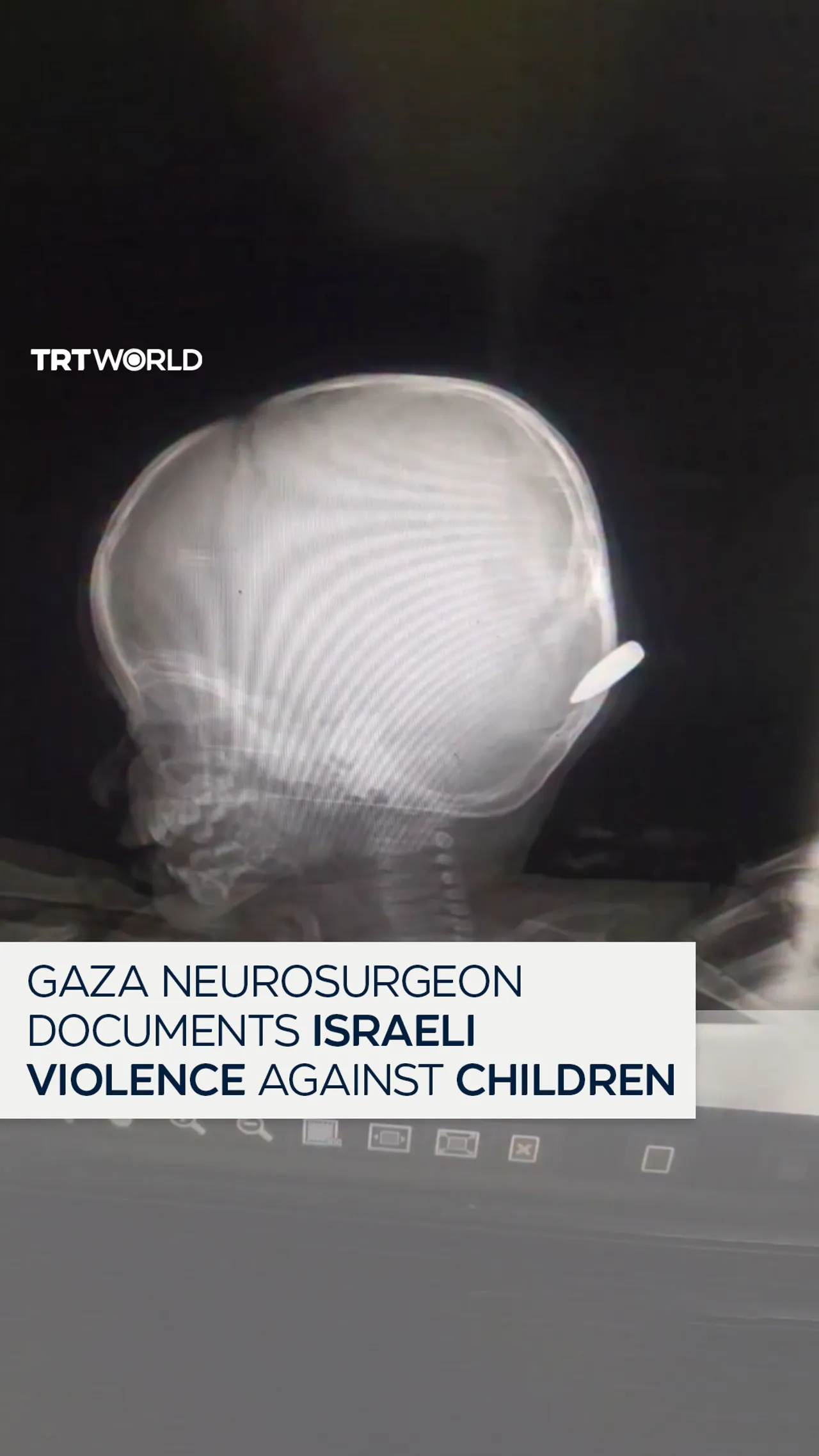 Gaza neurosurgeon shares evidence of Israeli attacks on Palestinian children.